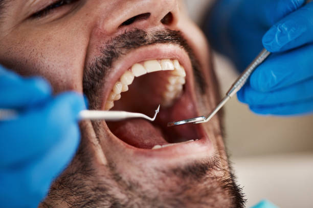 Best Dental Bonding  in Cannelton, IN