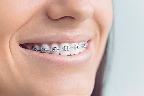 Dental Bonding in Cannelton, IN